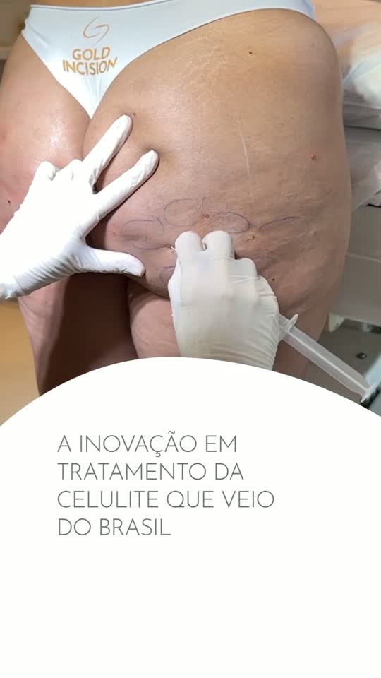 Miniatura do vídeo: A inovação no tratamento da celulite que veio do Brasil