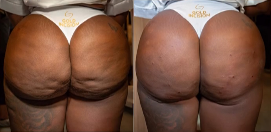 Antes e depois do tratamento de celulite da Jojo Todynho com o método GoldIncision