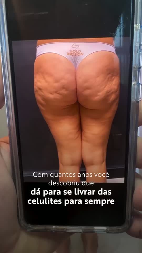 Miniatura do vídeo: Dá para se livrar das celulites para sempre
