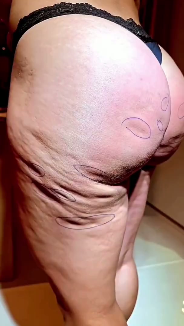 Miniatura do vídeo: Celulite não é só estética