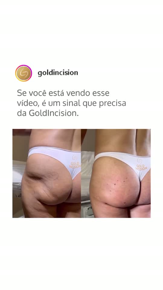 Miniatura do vídeo: Sinais de que você precisa do GoldIncision